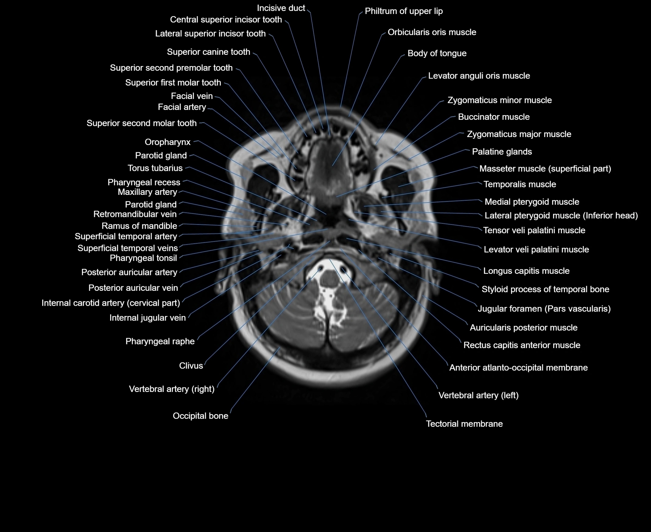MRI Neck 3D labelled cross section anatomy axial 3t image-00001-00019.webp